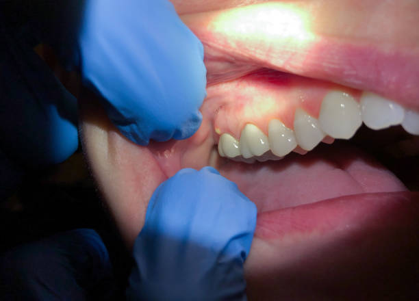 Best Emergency Dental Care for Broken or Chipped Teeth in De Witt, NY